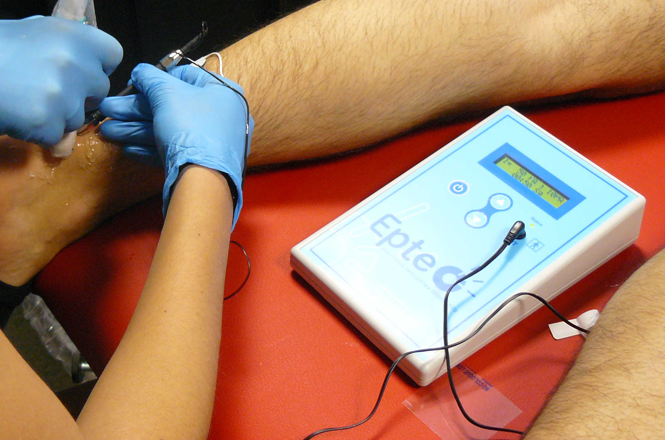 Electrolysis with EPTE on the Achilles Tendon